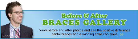 Before & After Braces Gallery